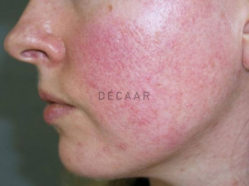 nhiễm corticoid nặng